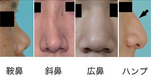 鼻の変形 一般社団法人 日本頭蓋顎顔面外科学会